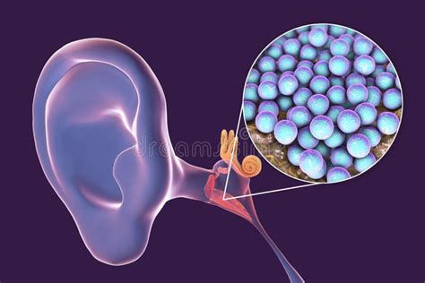 Otitis Media Inflammatory Disease Of The Middle Ear Stock Illustration