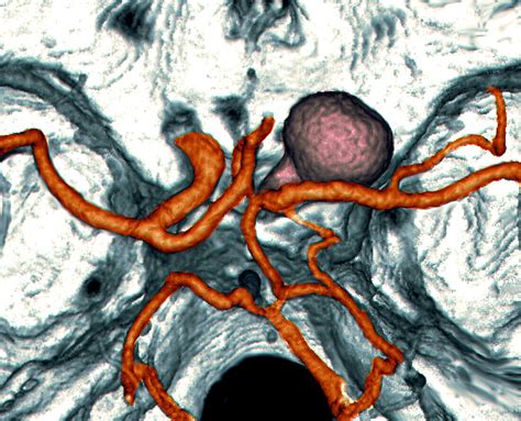 Subarachnoid Hemorrhage Ct Angiogram Bild Kaufen Science