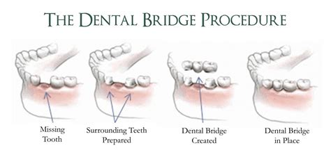 Dental Bridges Procedures Santarsiero Family Dentistry