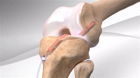 What is access control list? All-Inside ACL Reconstruction with Arthrex® GraftLink ...