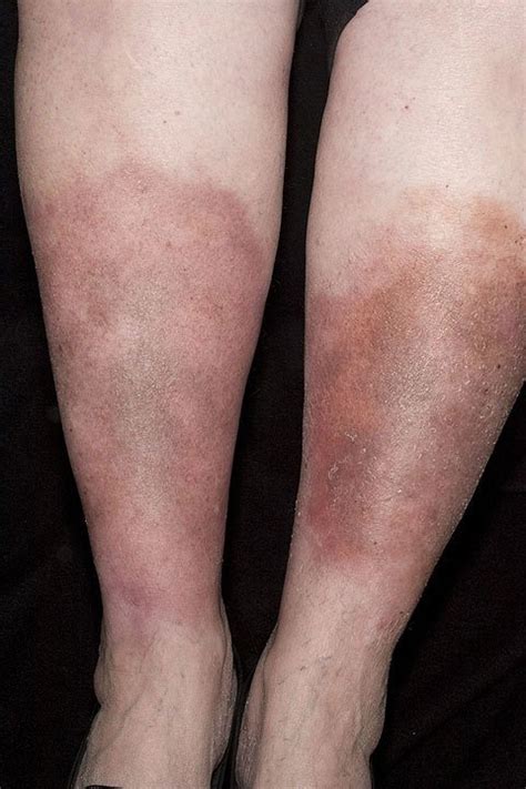 Stasis Dermatitis Symptoms Causes And Treatment