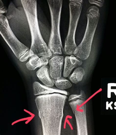 Wrist Xray Shows Buckle Fractures Of The Radius And