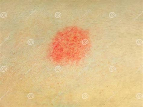 Skin Disease Stock Photo Image Of Dermatitis Infect 32518320