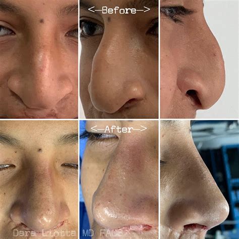 Cleft Lip And Nose Dr Dara Liotta