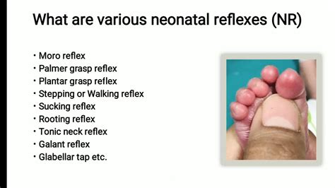 Neonatal Reflex Plantar Grasp Reflex Pediatrics Youtube