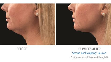 How To Get Rid Of Your Double Chin Dr Michael Kerin Blog