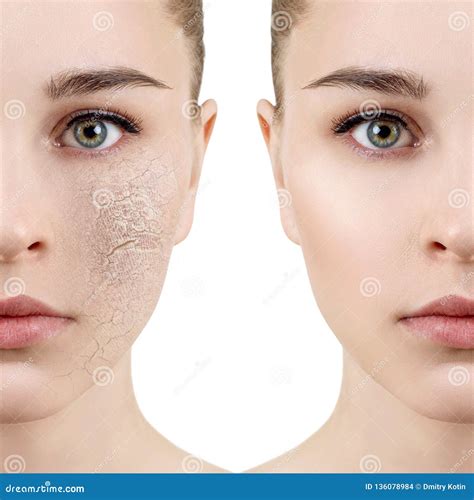 Young Woman With Dehydrated Skin Before And After Treatment Stock