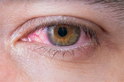 Coronavirus And Your Eyes What You Need To Know Eye Medical Center