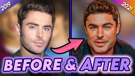 Zac Efron Before After Jaw Surgery Ignorant Steel