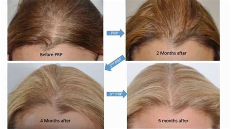 Top 48 Image Hair Implants For Women Vn