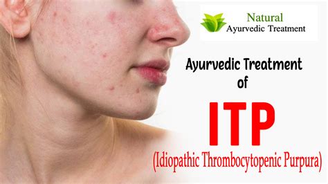 Ayurvedic Treatment For Idiopathic Thrombocytopenic Purpura Itp