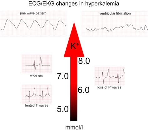 5 Ecg Changes Of Hyperkalemia You Need To Know Acadoodle Medium