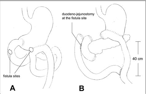 Modified Duodenal Diverticulization Technique For The Management Of