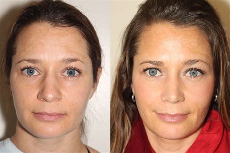 Before And After Open Rhinoplasty Plastic Surgery