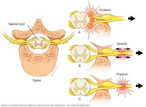 Brachial Plexus Injury Symptoms And Causes 2023