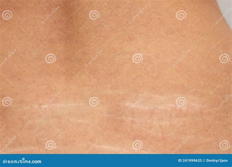 Stretch Marks On The Lower Back Stock Image Image Of Loss Human