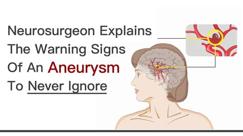 A ruptured aneurysm causes bleeding into the brain (subarachnoid hemorrhage). Brain Surgeon Explains the Warning Signs of An Aneurysm to ...