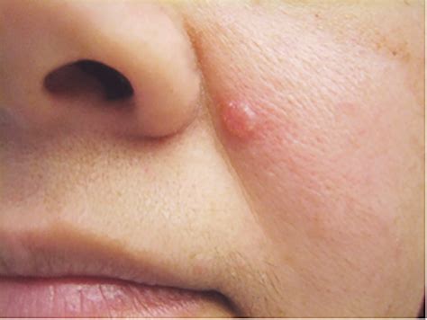 Skin Cancer White Spots On Face Cancerwalls