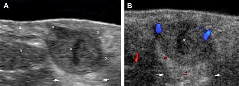 Urticarial Lesion Located On Patient39s Axilla Download