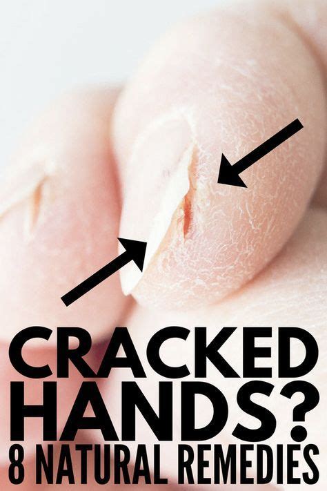 Severely Cracked Hands 8 Tips And Remedies For Fast Relief In 2020 Dry