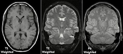 Examples Of T1 Weighted T2 Weighted And Pd Weighted Mri Images 5