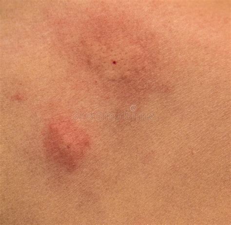 Mosquito Bite Stock Image Image Of Irritated Bitten 59967897