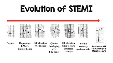Ecg Changes With Stemi Images And Photos Finder