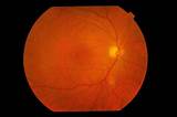 Treatment For Hole In Retina Of Eye Photos