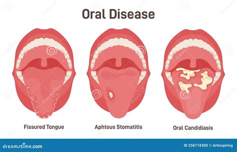 Tongue Problems Set Fissured Tongue Oral Candidiasis And Aphthous