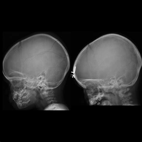 Pediatric Skull Fracture Pediatric Radiology Reference Article