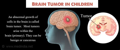 Signs Of A Brain Tumour In Child Overview Of Headaches From A Brain