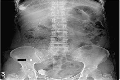 Perforated Appendicitis Caused By Foreign Body Ingestion Surgical