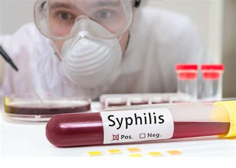 Wie Wird Ein Test Auf Syphilis Durchgeführt