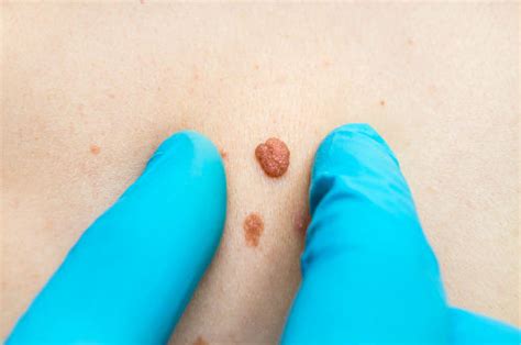 What Are Your Options For Cherry Angioma Removal