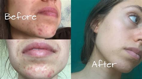 How I Healed My Hormonal Acne My Acne Story Youtube