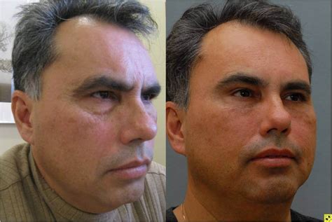 Brow Lift Johns Hopkins Facial Cosmetic Surgery