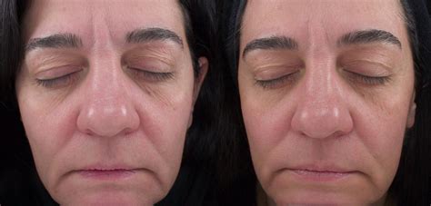 Chemical Peels And Microdermabrasion For Rochester Victor And Syracuse Ny