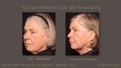 View The Before And After Gallery For Laser Skin Resurfacing From Real
