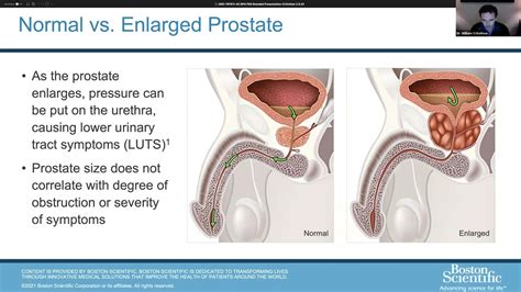 Dr William Critchlow S Webinar On Bph Enlarged Prostate Youtube
