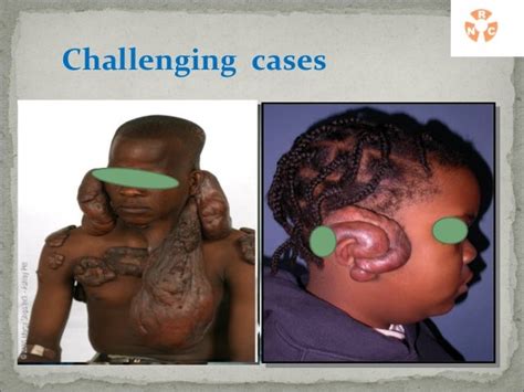 Keloid Disease Case Presentation