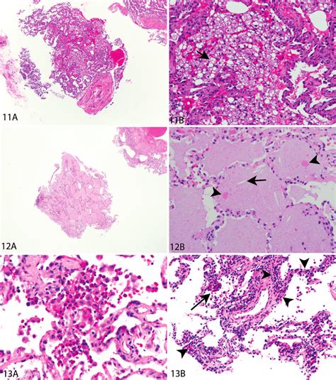Exogenous Lipoid Pneumonia In A Transbronchial Lung Biopsy A Low