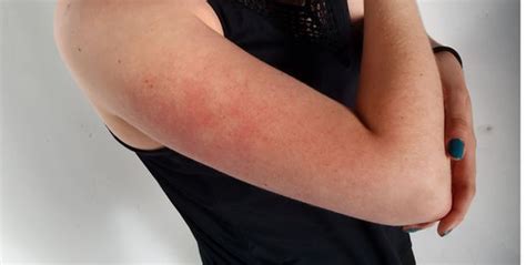 Why You Get Those Red Bumps On Your Arms And How To Get Rid Of Them