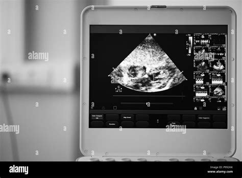 On The Screen Of A Modern Ultrasound Scanner A Heart Image With An