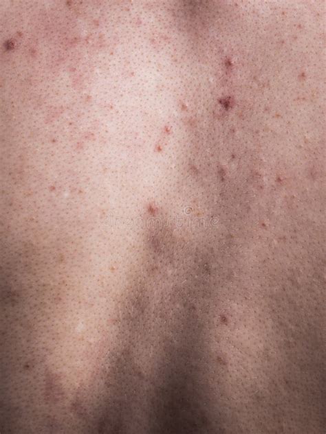 Closeup Human Skin With Problem Stock Photo Image Of Disease Spot