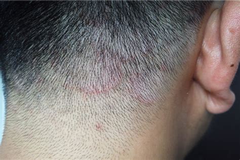 Ringworm In Humans On Head
