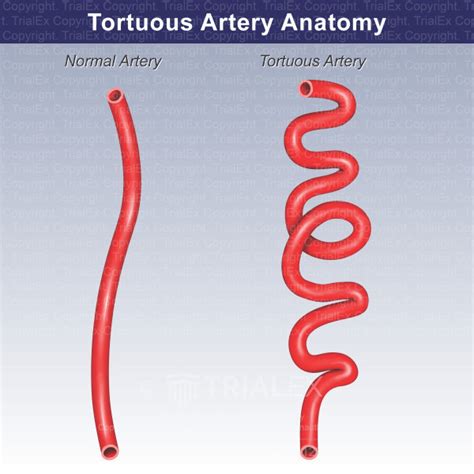 Tortuous Artery Anatomy Trial Exhibits Inc