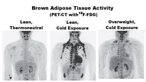 Brown Fat Could Play Key Role In Fighting Obesity