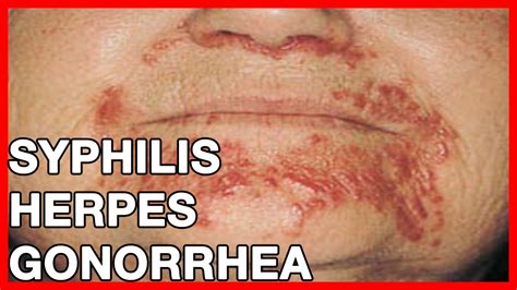 Symptoms Of Syphilis Herpes Gonorrhea What Are Stds Treatment And