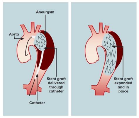 Acute Aortic Syndrome In Primary Care Singhealth
