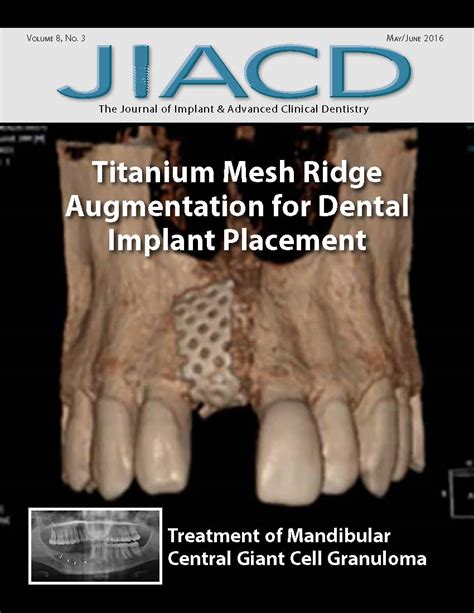 Titanium Mesh Ridge Augmentation For Dental Implant Placement — Jiacd Jiacd